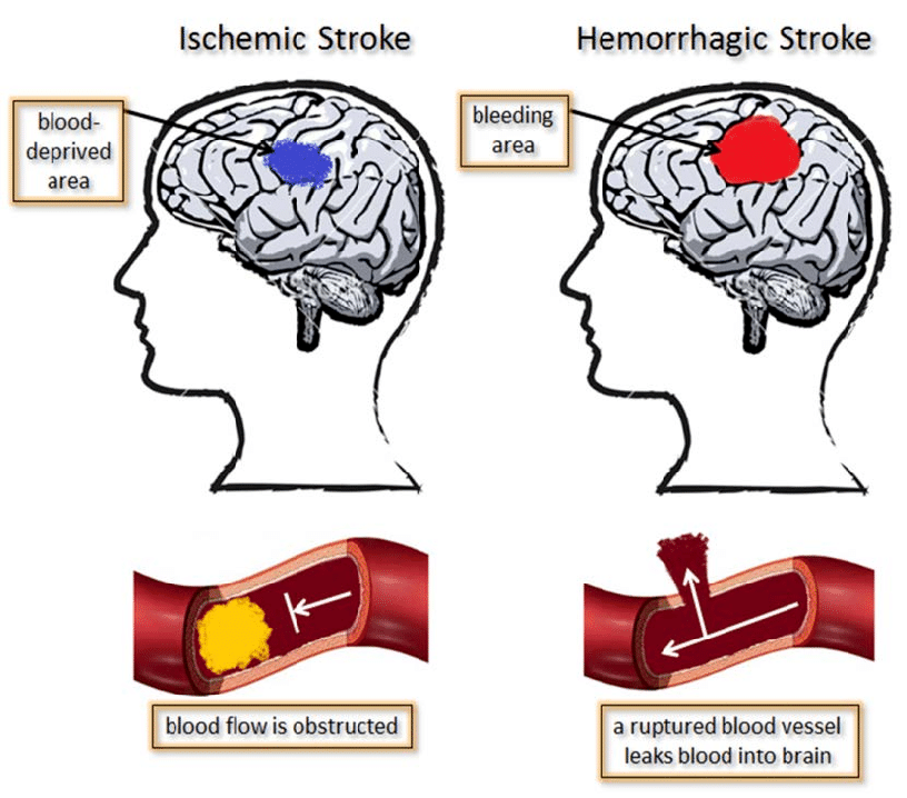 Medical Management of Acute&nbsp;Strokes